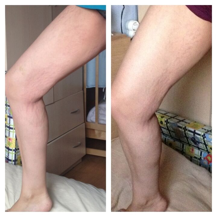 γόνατο πριν και μετά